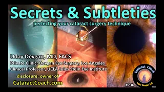 compilation video: secrets and subtleties to perfecting your cataract surgery technique