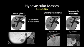 HypoVascular Masses of the Liver