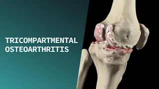 Tricompartmental Osteoarthritis