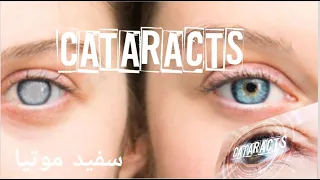 Cataracts |Causes, Risk Factors, Subtypes (Cortical, Nuclear, Posterior Subscapular) Treatment.