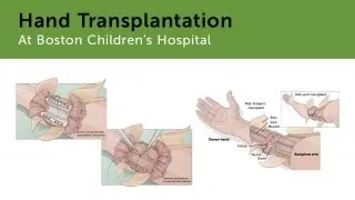 Hand Transplantation at Boston Children's Hospital