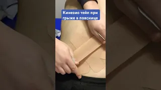 Кинезио тейп при болях в пояснице