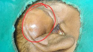 serroma of ear pinna.ear pinna pesudocyst. dr jalil mujawar