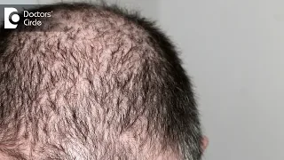 Minoxidil for hair loss - Dr. K Prapanna Arya