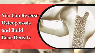 You can reverse osteoporosis and rebuild bone density - According to the hundreds of studies. Part 1