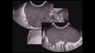 Pediatric Chest Ultrasound