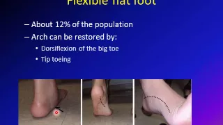 flat foot/ pes planus/ vulgus foot