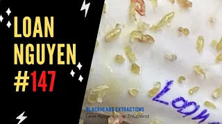 Best blackheads extractions (147) | Loan Nguyen