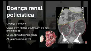 DIETA CETOGÊNICA REDUZ PROGRESSÃO DA DOENÇA RENAL POLICÍSTICA | APRENDA NUTRIÇÃO