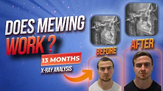 Does Mewing Really Work For Adults? 13 Month Before/After X-Ray Analysis