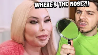 She Had 100+ Surgeries 👁️👃👁️ But Lost Her Nose...