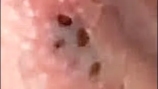 Blackheads behind ears . 幫別人擠乾淨耳朵上黑頭