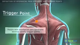 Myofascial Pain Syndrome and Trigger Points. Definition