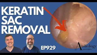 KERATIN SAC REMOVAL FROM EAR - EP929