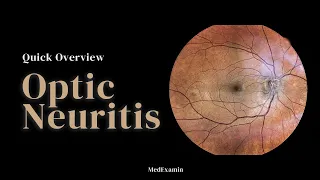 Optic Neuritis - Quick Overview for Exams in less than 2 minutes