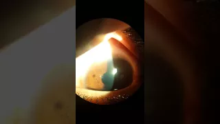 Corneal Rust removal by smart ophthalmology tips slitlamp adapter