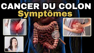 SYMPTÔMES les plus fréquents du CANCER DU COLON (cancer colorectal)