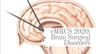 eMRCS 2020: Brain Surgical Disorders