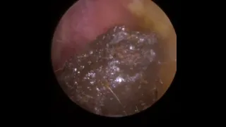 921 - Difficult Ear Wax Removal from Both Ears