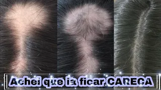 Alopecia Areata Produtos q Usei pra RECUPERAR MEU CABELO