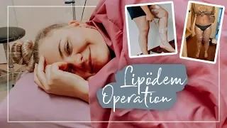 MEINE 1. LIPÖDEM OPERATION | Liposuktion, Ergebnis & Heilungsprozess (Vlog)