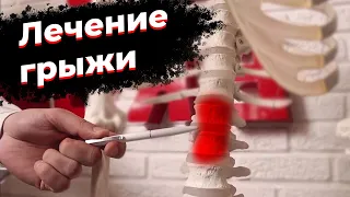 Забудьте о грыже навсегда! Лечение грыжи позвоночника. Тракционный стол для вытяжения позвоночника