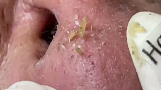 Nose  Blackheads Removal with Hari's Beauty - 2022