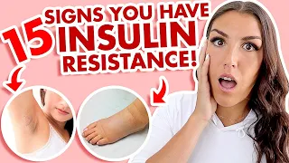 Insulin Resistance Symptoms (CAN'T Lose Weight? THIS Is WHY!) 2022