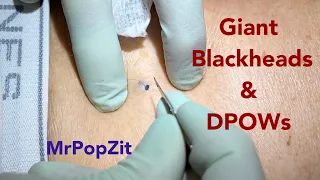 Large blackheads extracted. DPOWs packed full of content expressed. Spectrum of blackheads displayed