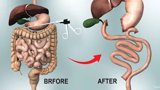 Gastric Bypass Y Surgery - Roux en Y 2022 3D Animation