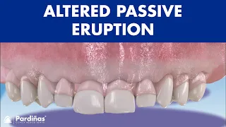 ALTERED PASSIVE ERUPTION and altered active - Consequences and treatments ©