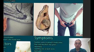 Testicular Cancer Symptoms, causes and treatment