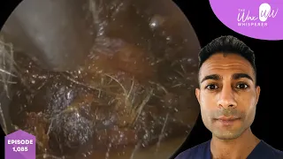 1,085 - Very Dark Ear Wax & Dead Sticky Skin Removal