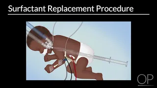 Surfactant Replacement in Neonates by B. Walsh | OPENPediatrics