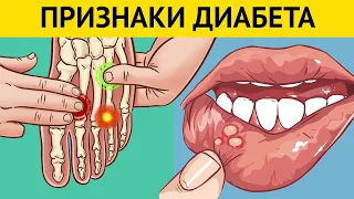 10 ранних признаков того, что у вас ДИАБЕТ. Многие игнорируют эти симптомы. Профилактика диабета