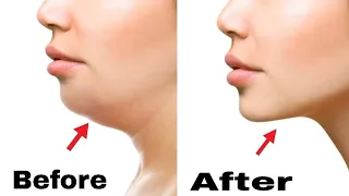 2 Easy Face Exercise To Get Rid Of Double Chin | Doctor Vivek