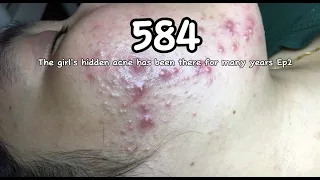 |584| The girl's hidden acne has been there for many years Ep2