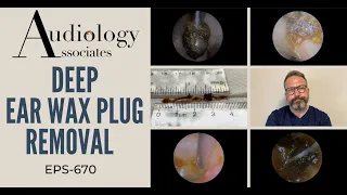 DEEP EAR WAX PLUG REMOVAL - EP670