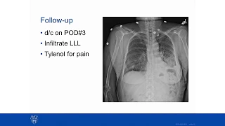 Multifocal Lung Cancer Discussion and Case Presentation - Mayo Clinic