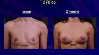 E-06 - Results-Mammaplasty A.N.A. (Augmentation Natural Asymmetric)