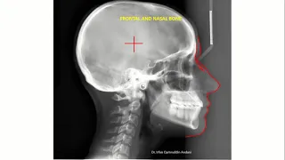 Lateral Cephalometric radiograph tracing: Ceph tracing 2