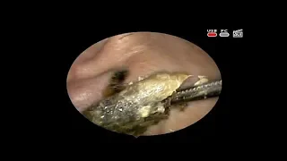 #Earwax removal Удаление #серной пробки #ЛОР КЛИНИКА ОБРАЗЦОВА