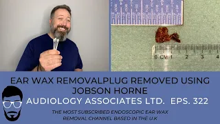 PLUG OF EAR WAX REMOVED USING JOBSON HORNE - EP 322