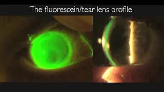 msd™ mini scleral lens Part 2-Fitting: presented by Dr. Stephen P. Byrnes, O.D.