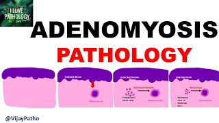 ADENOMYOSIS : Pathology, Clinical Features, Diagnosis & treatment