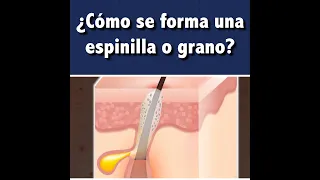 ¿Cómo se forma una espinilla o grano? 👩🏻‍⚕️l Dra. Pau Zúñiga CLIPS