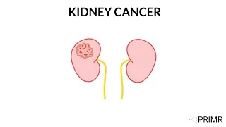 Doctor Explains Kidney Cancer Overview