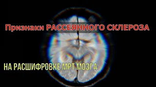 Признаки РАССЕЯННОГО СКЛЕРОЗА на МРТ РАСШИФРОВКЕ головного мозга и шейного отдела позвоночника