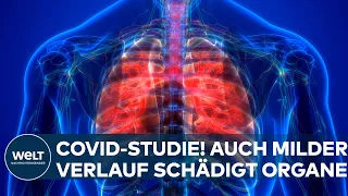 CORONA-STUDIE: Hamburger Forscher entdecken Schädigungen an Organen auch bei mildem Covid19-Verlauf