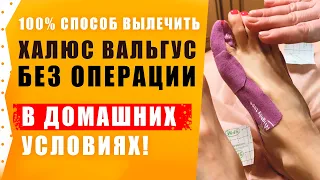 Халюс Вальгус – Лечение без операции в домашних условиях ! Подагра.